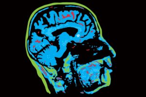 mri-brain-scan